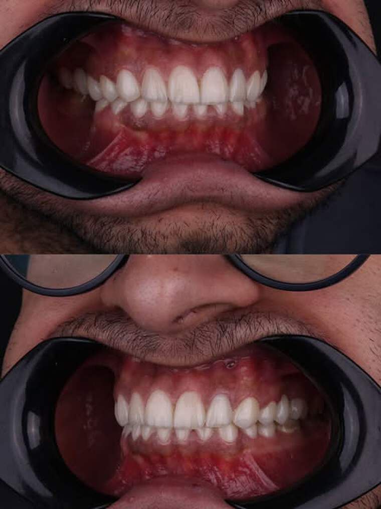 Restorative dental case showing rebuilt tooth alignment and edge shape