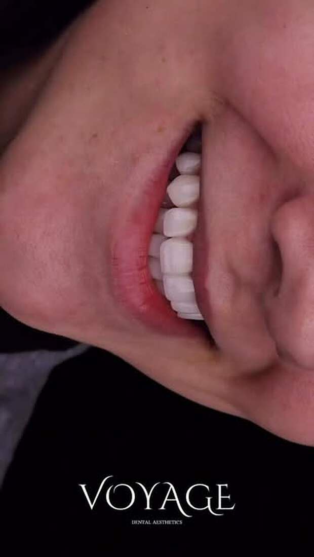 Close-up detail of finished porcelain veneers showing surface texture and translucency